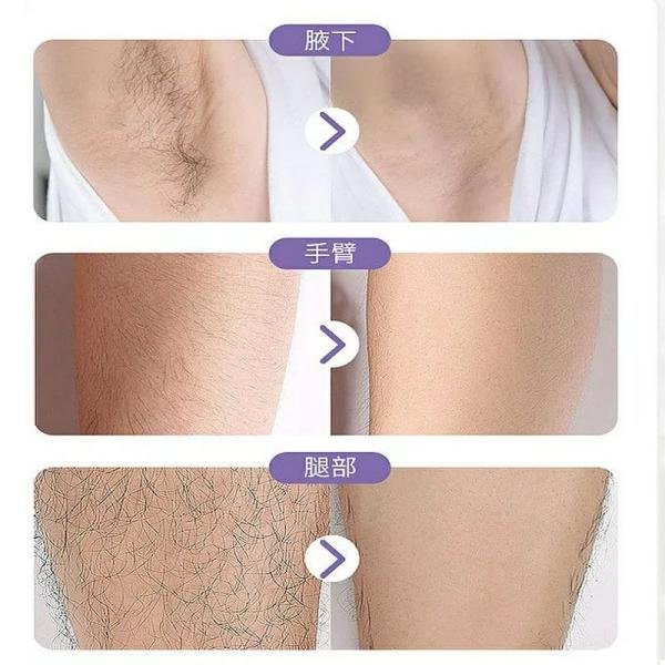 Epilator